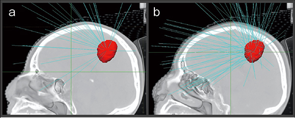 図3　サイバーナイフにおける照射方法の違い a： isocenterを持つ照射 b： isocenterを持たない照射（non-isocenter） aは短時間で照射可能だが大きな病変には不向き。bは形が複雑で大きな病変にも対応できる。通常はbを用いる。