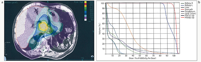図3　膵臓がん術後局所再発症例 a：線量分布図　b：DVH