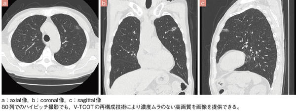 症例2 胸腹部（ハイピッチ撮影）