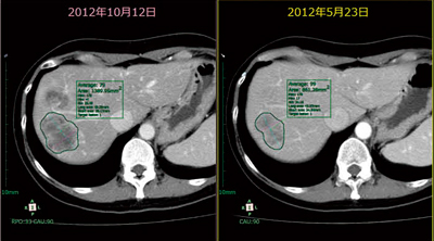 RECIST計測機能 2010年に改訂したRECISTガイドラインに準拠