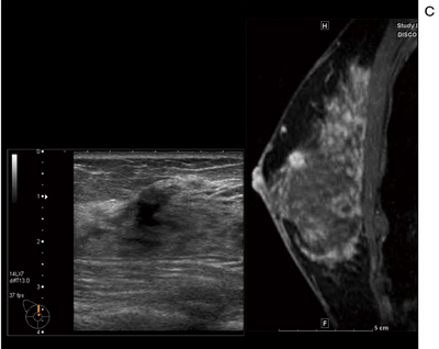 c：Bモード画像，造影MRI矢状断像