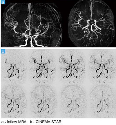 症例1：もやもや病（6歳，男児）の頭部MRA