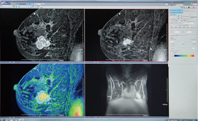 症例2：Aquarius NET Clientビューアーによる乳腺領域の解析例