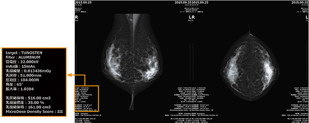 実際の撮影画像。撮影方向を選ぶと自動で最適な撮影条件が設定される。右MLOの撮影線量は約0.8mGy。 撮影条件とともに，スペクトラルイメージングによる乳腺密度がDICOM情報として表示される。