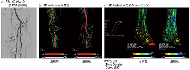 2D Perfusion画像例：下肢インターベンション2D Perfusion画像例