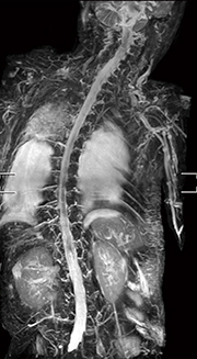 症例3：脳脊髄液減少症のMR myelography（3D-STIR）