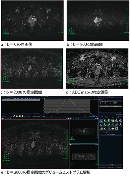 図5　“Computed DWI”による前立腺DWI画像解析