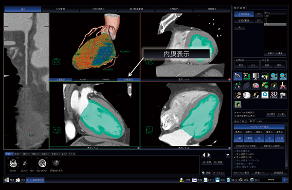 図2　心内膜カラーマップ表示機能イメージ