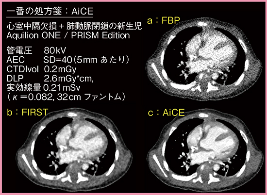 図2　低線量・高画質の一番の処方せん：AiCE