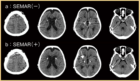 図5　症例5：SEMARの適用ありとなしの画像比較 （参考文献4）より引用転載）