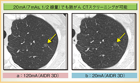 図2　AIDR 3Dを用いた1/2線量（a），1/12線量（b）の画像比較（画像ご提供：滋賀医科大学・永谷幸裕先生）