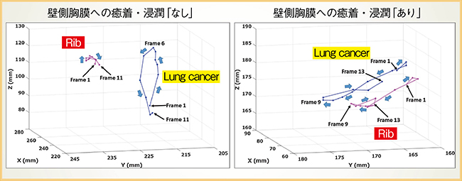 図3　呼吸ダイナミックCTによる肺がん胸壁浸潤の評価 （参考文献6）より引用転載）