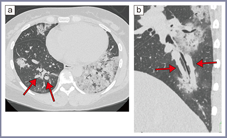 図3　30歳代，女性，中等症ⅡのCOVID-19肺炎（2020年の症例）4） a：高精細CT軸位断像　b：病変部分の斜位断拡大像