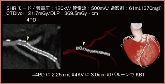図2　ステントストラットの拡張状況の評価 60歳代，60kg，2.25mmのプラチナ合金DES留置例