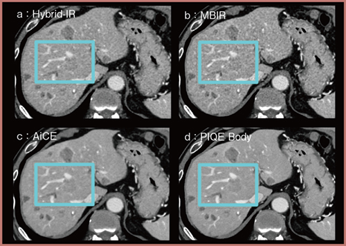 図3　肝ダイナミックCT門脈相における画像比較