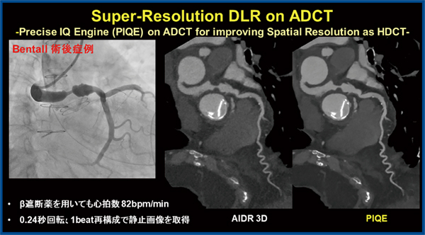 図3　Bentall 術後症例におけるPIQEを用いたSuper Resolution DLR Bentall術後症例のCTAにPIQEを使用することにより，Hybrid-type Iterative Reconstructionである「Adaptive Iterative Dose Reduction 3D（AIDR 3D）」に比して著明な画質改善が認められる。