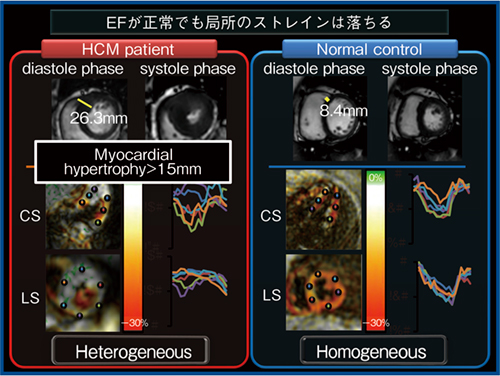 図1　HCM症例と正常例のストレインの比較（参考文献2）より引用転載）