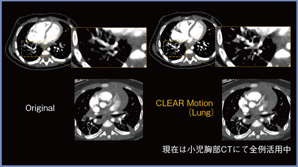 図4　小児胸部CTにおけるCLEAR Motionの活用