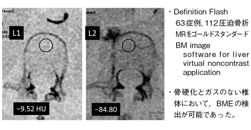 図2　脊椎圧迫骨折におけるDEイメージングによるBMEの評価2）