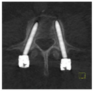 図7　loosening of pedicle screws4）