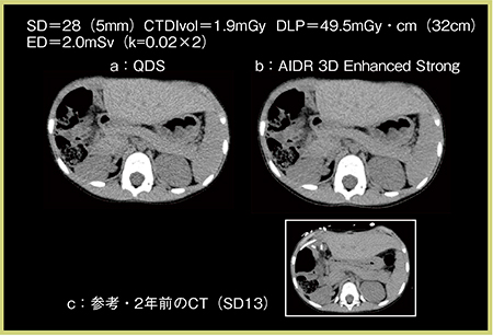 図3　症例2：小児体幹部の単純CT a：QDS　b：AIDR 3D Enhanced Strong　c：2年前のCT（SD13）