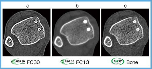 図3　足関節CT