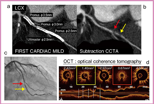 図3　症例2：ステント留置症例 a：FIRST CARDIAC MILD画像 b：冠動脈サブトラクションCT画像 c：CAG　d：OCT