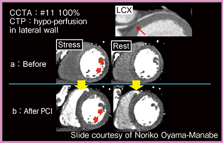 図3　症例3：CTPによるPCI前後の血流の変化（画像ご提供：北海道大学・真鍋徳子先生）