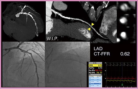 図5　症例4：狭心症（三枝病変）疑い症例のLADのカテーテルFFRとCT-FFR（W.I.P.）
