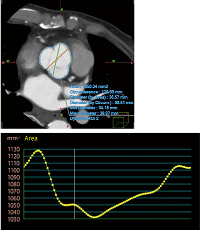 図3　Dynamic ROI機能によるバルサルバ洞計測