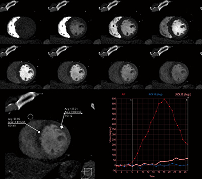 図1　心筋Dynamic Perfusion
