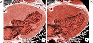 図4　肥大型心筋症（HOCM）のPhyZiodynamicsによる評価 a：術前　b：術後