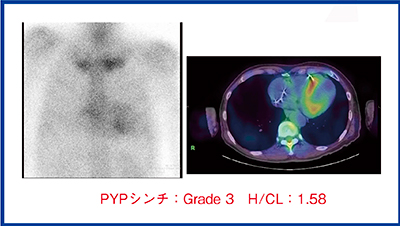 図3　症例2のピロリン酸シンチグラフィ