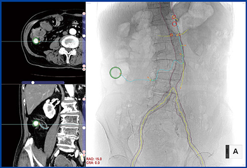 Ziostation2による“IVRプランニング” 血管IVRモードでは，CTデータを読み込むことで仮想透視画像の作成から主要血管の抽出までが自動で行われる。ターゲット（緑の○）を指定することで，そこに至るルート（血管）を自動抽出し複数（最大3本）表示されるため（水色，黄色），IVRの際の最適なルートを事前に確認できる。さらに，主要な血管の分岐部にはマーカーが表示され，画像を回転させることでカテーテルの挿入角度を確認でき，術中の手技をサポートする。