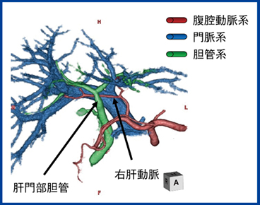 図5　肝門部胆管がん術前のグリソン鞘の描出