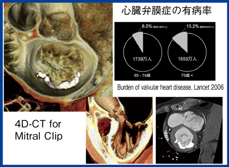 図7　Ziostation REVORASによるMitral Clipの4D-CT解析