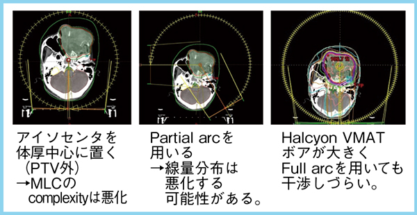 図1　Halcyonの利点：大型ボア径