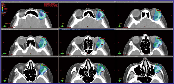 図2　‌症例2：眼窩原発の辺縁帯B細胞性リンパ腫MALT型 stageⅠに対するRapidArcを用いたISRTの例