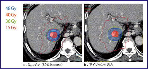 図1　処方法による線量分布の相違