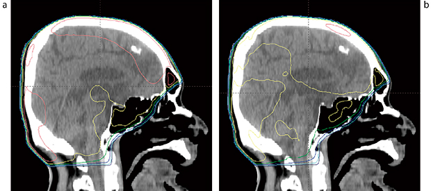 図4　FFFによる全脳照射の平坦度改善 a：10MVX線左右対向2門照射では，ピーク線量は照射野中心の110％に達する。 b：10MVFFFX線を12％混合することで，ピーク線量は106.1％に低下した。