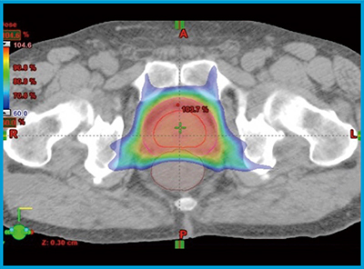 図1　IMRTの線量分布図