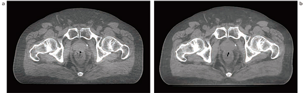 図1　Standard CBCTとiCBCTの比較 a：standard CBCT　b：iCBCT