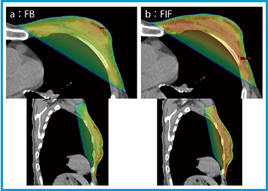 図4　Halcyonによる乳房の線量分布 a：FB max：109.8%，min：92.2%，mean：101.3%，MU：272.6 /279.8 b：FIF max：102.8%，min：89.3%，mean：97.6%，MU：248.0（infield 17.9）/254.5（infield 18.5）