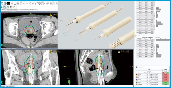 図2　Interstitial cylinderを用いて腟浸潤と傍組織を照射